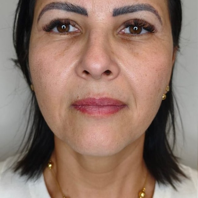 Reestruturação facial — antes
