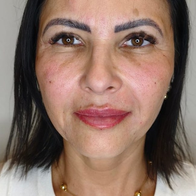 Reestruturação facial — depois