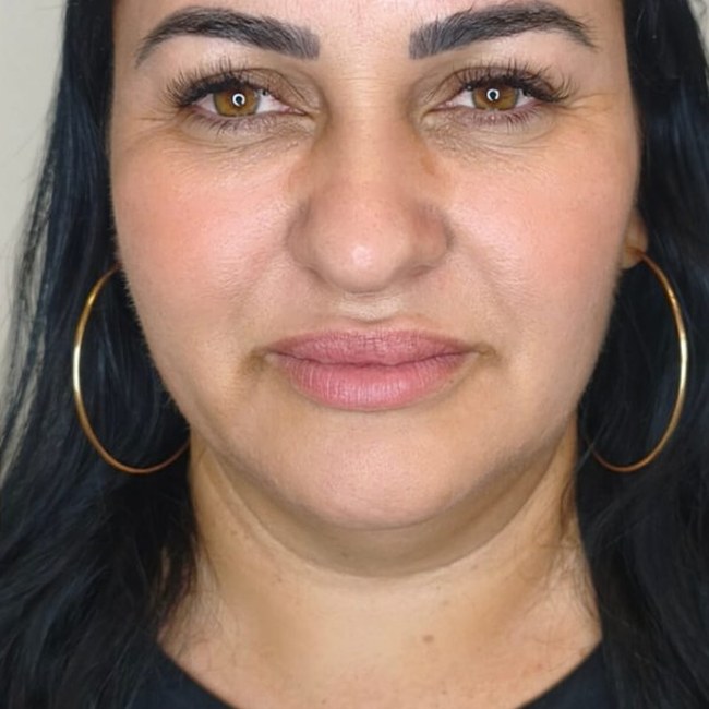 Reestruturação facial — depois