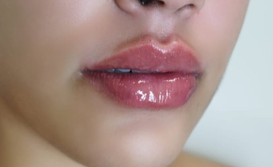 Imagem ilustrativa de Preenchimento labial